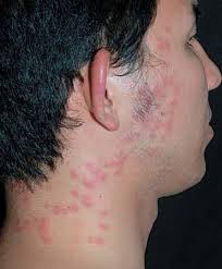 شركه مكافحه بق الفراش بالرياض